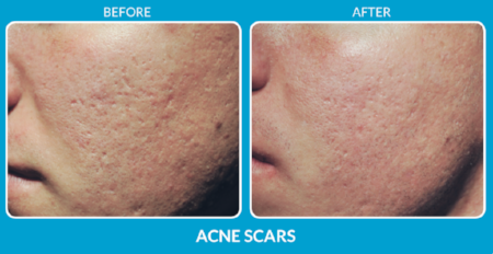 Acne Scars Treatment
