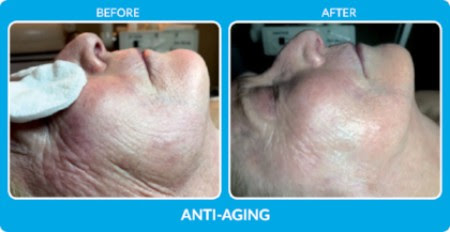 Anti-Aging with SkinPen in Florida