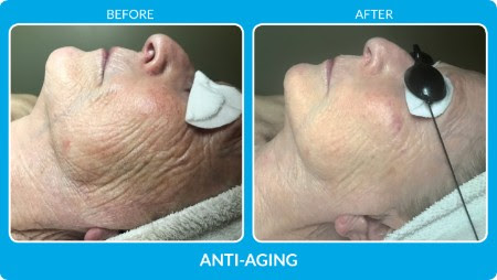 Before and After ofAnti-Aging Service