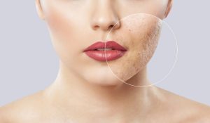 Read more about the article How is Cryosurgery Better than Other Methods of Removing Skin Imperfections in Naples, Florida?