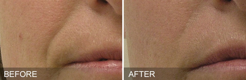 Before and After Hydrafacial Treatment