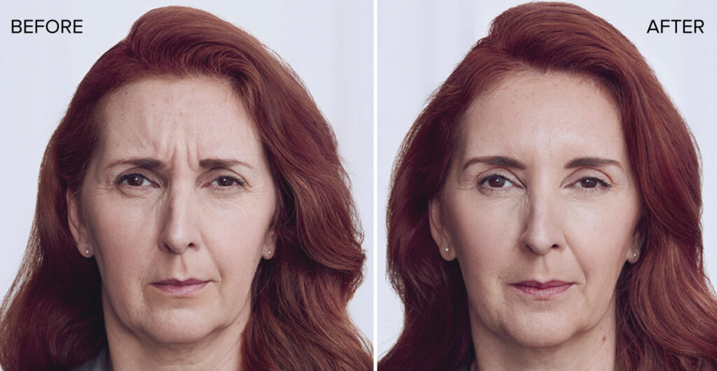 Botox before and after result