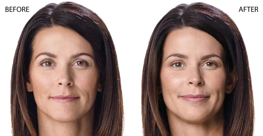juvederm Before and After