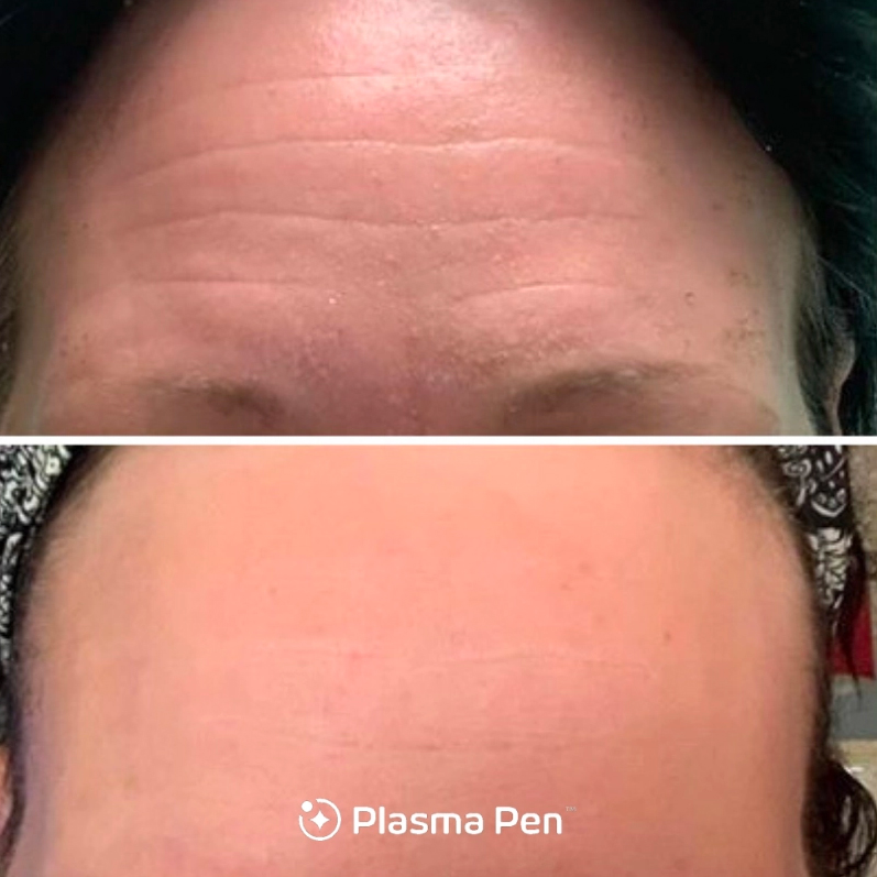 Plasma pen brow lift & Forehead-tightening