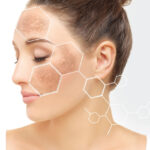 Effective Hyperpigmentation Treatments and Solutions