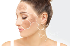 Read more about the article Effective Hyperpigmentation Treatments and Solutions
