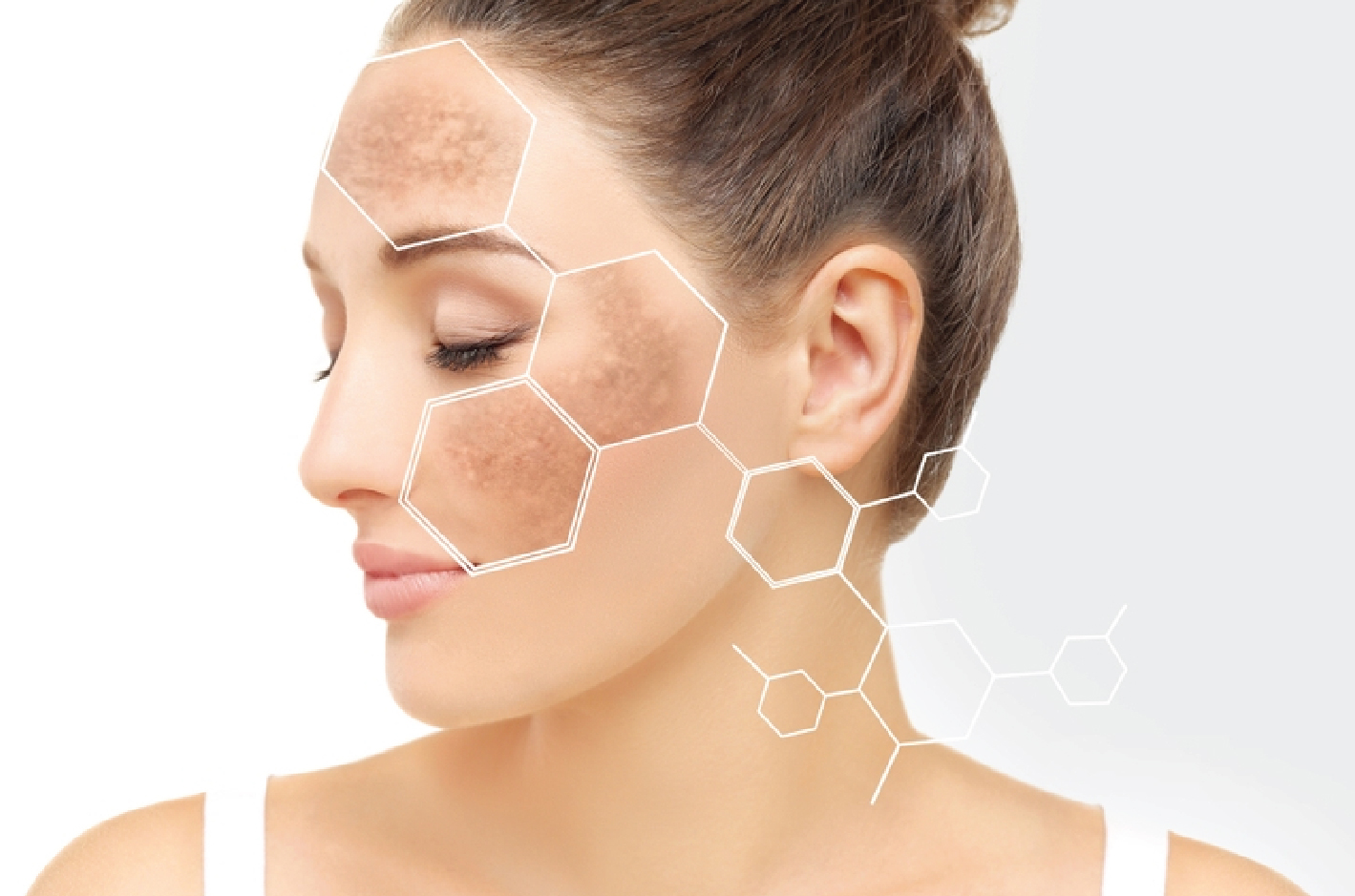 You are currently viewing Effective Hyperpigmentation Treatments and Solutions