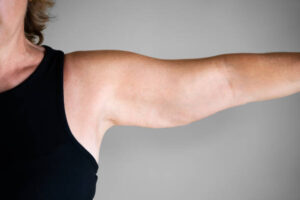 Read more about the article Revitalize Your Confidence: The Ultimate Guide to Arms Skin Tightening