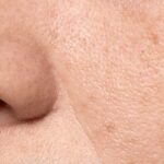 Tips for Reducing Enlarged and Congested Pores