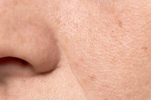 Read more about the article Tips for Reducing Enlarged and Congested Pores