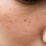 Unveiling Skin Spots: Types and Treatments