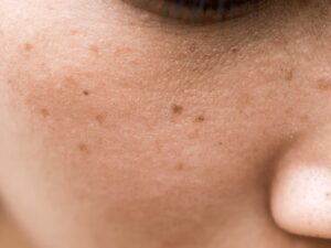 Read more about the article Unveiling Skin Spots: Types and Treatments