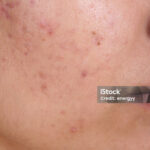 Rejuvenating Skin with Laser Treatment for Acne Scars